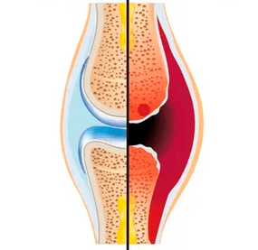 Der Aufbau eines gesunden und abgenutzten Gelenks mit der Bezeichnung Knorpelgewebe und Gelenkflüssigkeit.