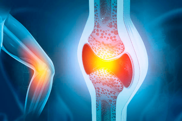 Vorbeugung von Gelenkerkrankungen.